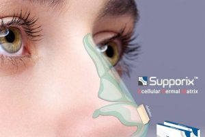 Bọc đầu mũi bằng chất liệu mô da nhân tạo Supporix