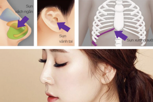Nâng mũi cấu trúc là gì? Nâng mũi cấu trúc sử dụng những loại chất liệu nào an toàn?