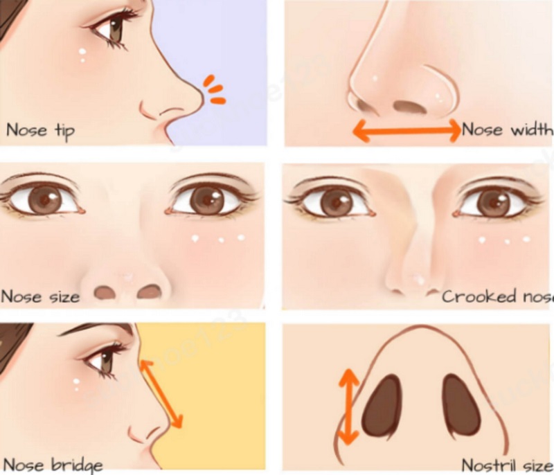 Một số biến chứng hậu phẫu thường gặp khi nâng mũi sụn tự thân