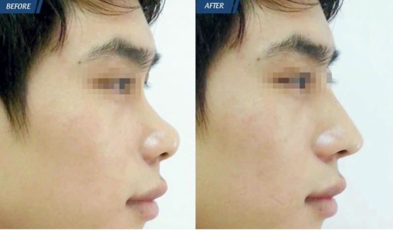 Tiêu chuẩn nâng mũi L-line cho nam giới và gợi ý những loại sụn nâng mũi phù hợp với dáng mũi L-line.