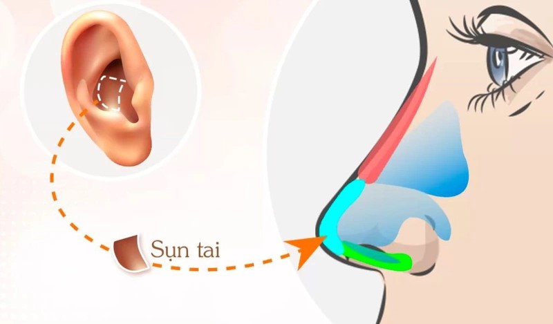 Sụn tai dẻo và có độ cong nhất định