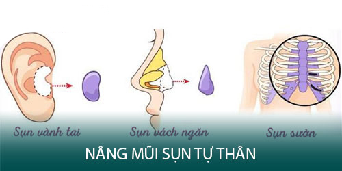 Sụn tự thân được lấy trực tiếp từ cơ thể bệnh nhân