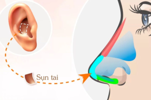 Nâng mũi bằng sụn tai của người khác: Nên hay không?