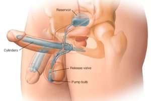 Giải pháp cấy ghép thể hang nhân tạo điều trị rối loạn cương dương